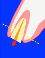 エクストリュージョン